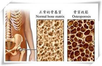 骨质疏松