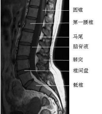 腰椎间盘突出症