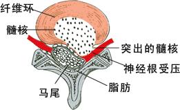 腰椎间盘突出有哪些危害表现