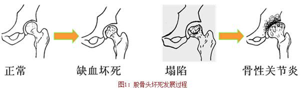 福州哪家医院治疗股骨头坏死好