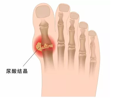 福州看痛风哪家医院好