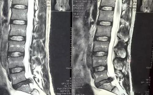 腰椎间盘突出去福州哪家医院椎间孔镜微创